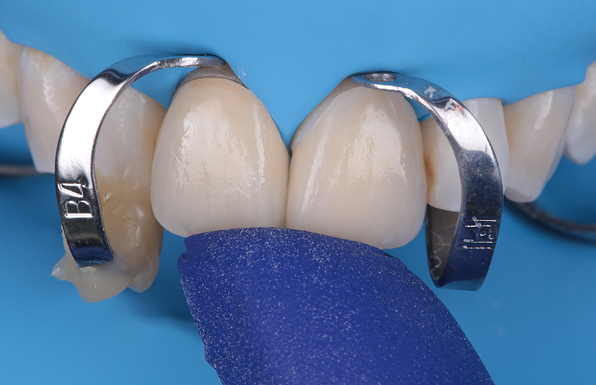 Finale Einprobe nach Trockenlegung. Bilder mit freundlicher Genehmigung von Dr. Paulo Monteiro.